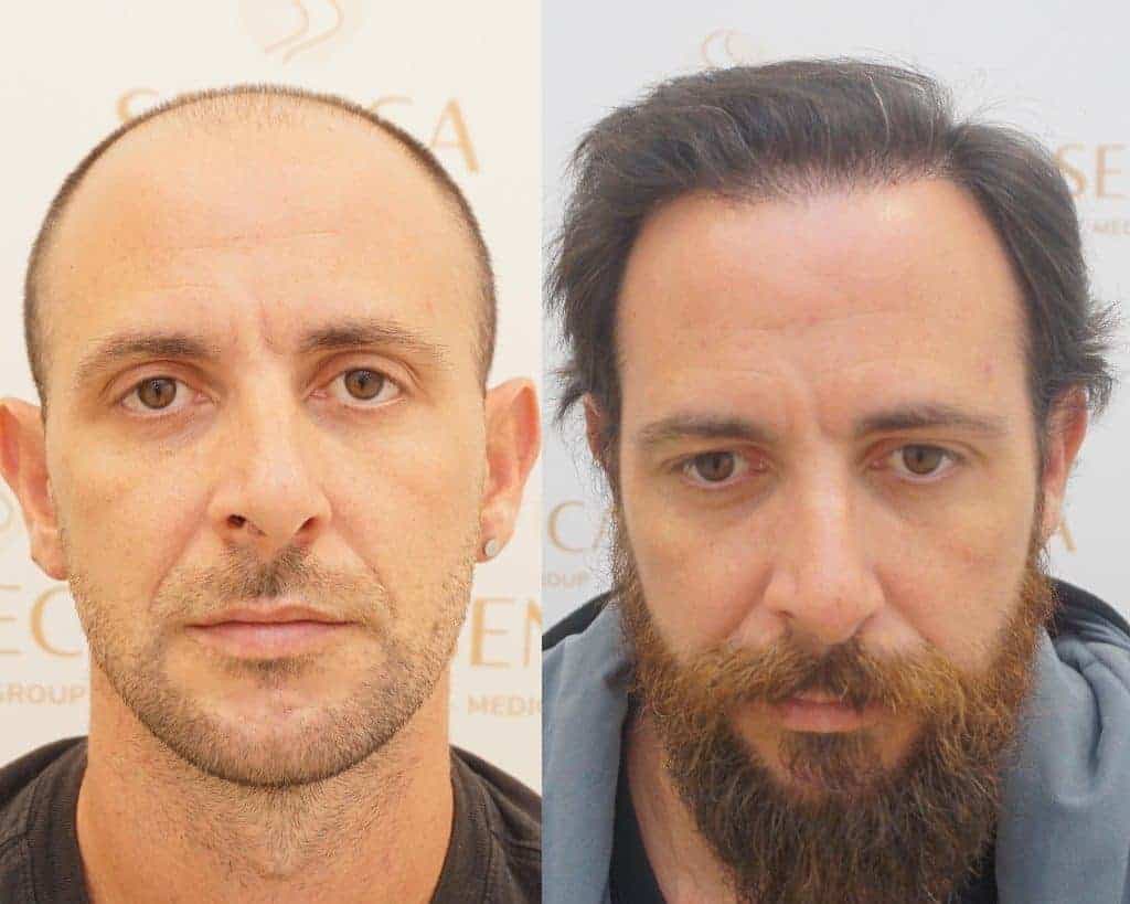 Affordable Hair Transplant UK – Professional Care You Can Trust