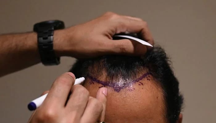 Hair Transplant Turkey: Get a Natural Hairline Transformation